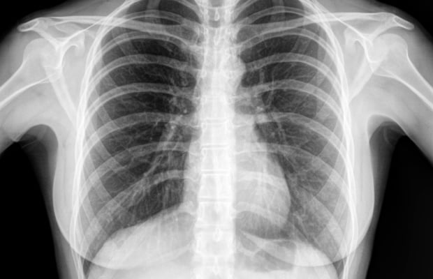 Chest X-ray Abnormality Detection