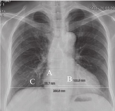 Cardiothoracic Ratio (CTR) Measurement