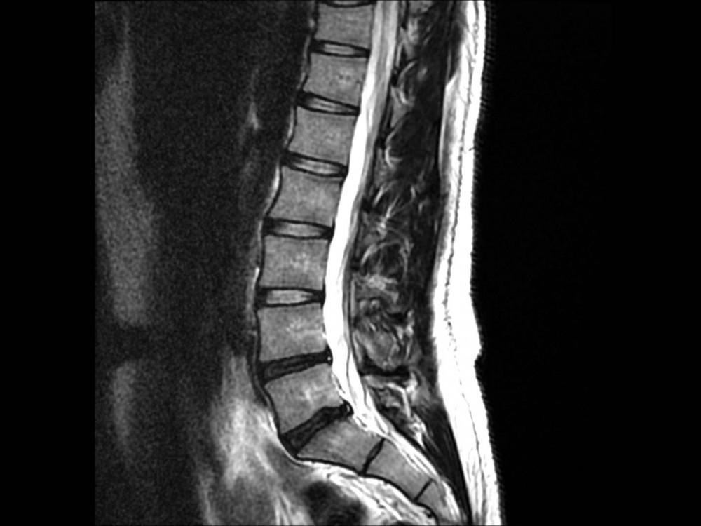MRI Lumbar Spine Analysis for spine Segmentation